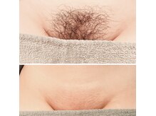 リバース(waxR B S)の雰囲気（VIOワックス脱毛は1度でこの仕上がり♪気になるムレ・ニオイに◎）