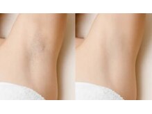 ディライト 名古屋駅店(Delight)/脇脱毛　においやムレにも