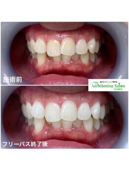 ホワイトニングサロン 名古屋駅店/【ホワイトニング施術例】