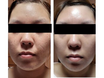 シェリモ(CHERIMO)/VOSサロンケア　ブラック　1回