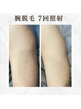 ボゴス(BOGOSS)/腕脱毛７回照射