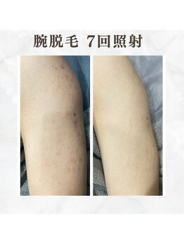 ボゴス(BOGOSS)/腕脱毛7回照射