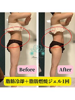 パラアモール(Paraamor)/脂肪冷却ビフォーアフター40代