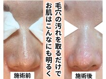 リアン(LIAN)/毛穴改善プレミアムコース