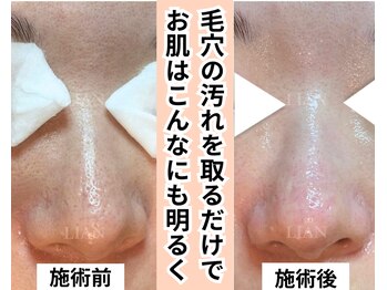 リアン(LIAN)/毛穴改善プレミアムコース