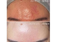 ニキビを繰り返す敏感肌プロセルセラピーズで肌質改善