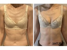 リール 新宿店(RIRE)/50代後半　バストアップ症例