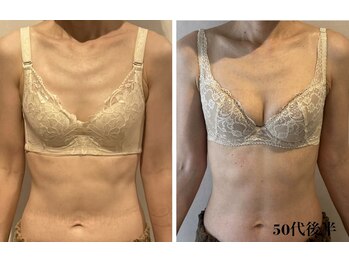 リール 新宿店(RIRE)/50代後半 バストアップ症例