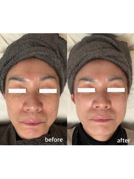 シエルビ(Ciel B)/光フォトのビフォーアフター