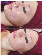 エリール(elire)/核酸DNA美容法　本格ニキビケア