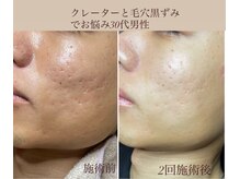 毛穴の開き.深いシワ.深刻な凸凹肌はプロセルフェイシャルへ