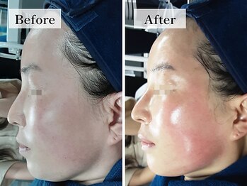 フローラル ビューティー(Floral-Beauty)/【ビフォーアフター】小顔エステ