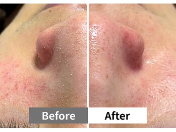 アーキ(ARCHI)/【稲沢/毛穴洗浄】毛穴洗浄