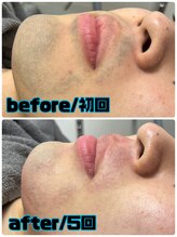 エリクサー 太田店(Elixir)/ヒゲ脱毛【5回！】