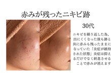 シャルナ(charna)/ニキビ／跡／赤み改善