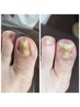 【初回限定 平日15時迄】 巻き爪補正 初見料3000円&衛星処理代2200円サービス