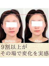 スウ(suu.)/Before-After【30代】1回