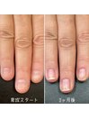 自爪育成3ヶ月コース