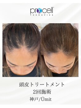 ユミト(Umit)/プロセルスカルプ
