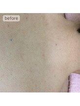 ビューティフィーサロン ベルル(Belulu)/背中～えりあし脱毛ビフォー