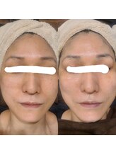 シス(SiS.)/ハーブピーリング