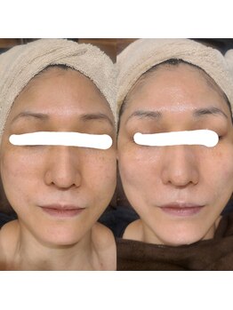 シス(SiS.)/ハーブピーリング