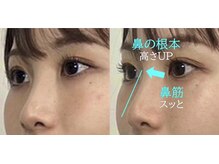 ラプリ 大宮店(Raplit)/隆鼻＋輪郭矯正40分10回