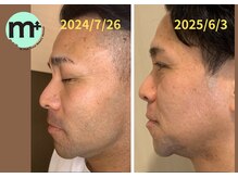 エムプラス 東戸塚(M+)/40代　ヒゲ脱毛