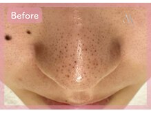 ミリ 千葉店(mili)/鼻の黒ずみを改善/毛穴