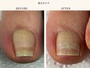 巻き爪改善ケア