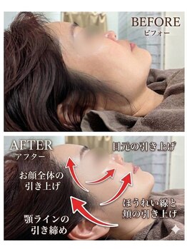 ミヨン ヨコハマ(Miyonne Yokohama)/LDM Aqua＋小顔ヘッドスパ上大岡