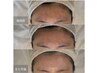 【ハリ艶が欲しい方】毛穴ケア/くすみ/ニキビケア ハーブピーリング剥離なし