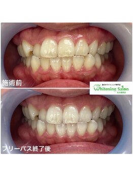 ホワイトニングサロン 名古屋駅店/【ホワイトニング施術例】
