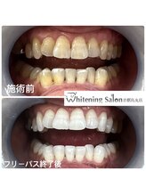 ホワイトニングサロン 京都烏丸店/ホワイトニング施術例