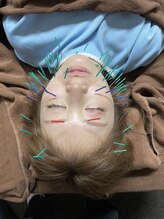 きらめき鍼灸治療院/他院に比べて本数多め！