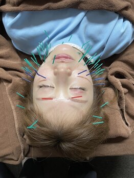 きらめき鍼灸治療院/他院に比べて本数多め!