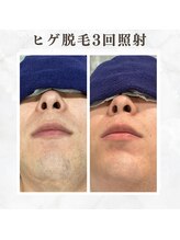 ボゴス(BOGOSS)/ヒゲ脱毛３回照射