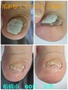 厚くて汚い爪どうにかして!
