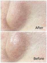 ハクミー(haku me)/☆毛穴汚れ黒ずみケア☆