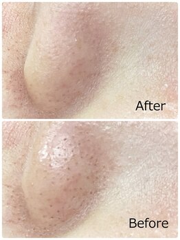 ハクミー(haku me)/☆毛穴汚れ黒ずみケア☆