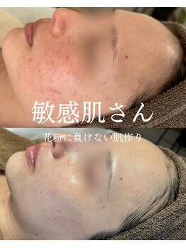 インテリウス(INteRius.)/敏感肌さん