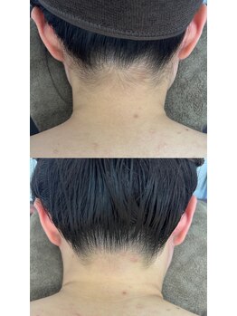 ミース 仙台長町店/うなじ矯正体験1回目!