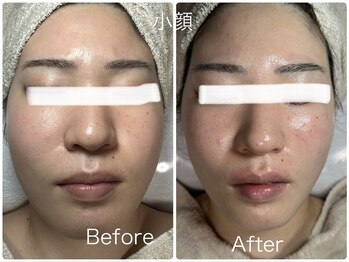 ルミネル 名古屋新栄(Luminelle)/小顔矯正