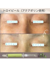 リラクゼーションサロン ラキ(laki)/ハーブピーリング