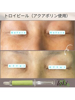 リラクゼーションサロン ラキ(laki)/ハーブピーリング