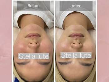 ステラルーテ(Stella lute)/ハーブピーリング 1回