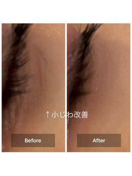 ルミエール(Lumiere)/２０代女性　小ジワケア