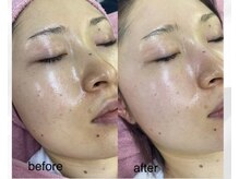 エマ(emma)/白玉アミノ酸スノーピーリング