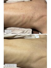 ピリナ 名古屋/【背中ハーブピーリング】症例