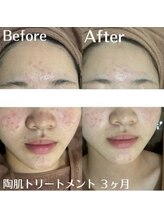 ホワイトアクア 中目黒店(WHITE AQUA)/ハーブピーリング ニキビ 肌荒れ